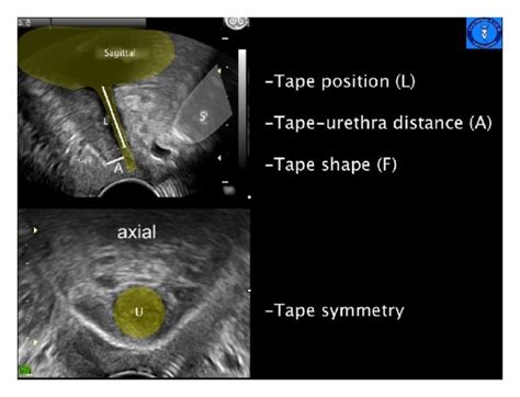 Pelvic Floor Ultrasound Images In A Sagittal Plane Above And Axial