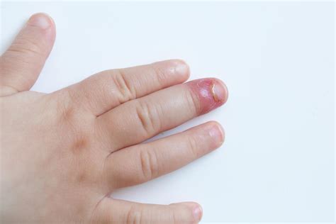How To Treat Paronychia An Infected Nail Medication Junction