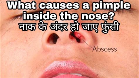 नाक के अंदर फुंसी Pimple Inside Nose Causestreatment And Home