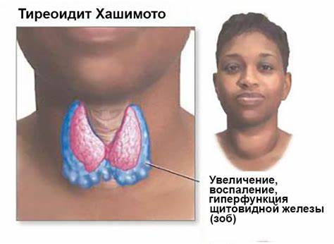 Гипертиреоз у женщин диета