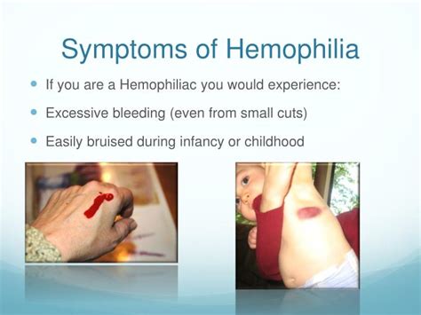 Bij hemofilie a ontbreekt het eiwit factor viii (8) volledig of gedeeltelijk. PPT - Hemophilia PowerPoint Presentation - ID:6496842