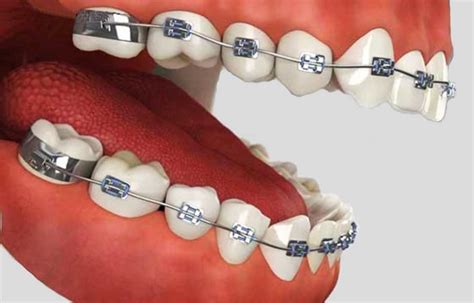 Dos And Donts When You Are Wearing Braces Dt Smile Care