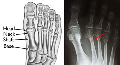 Toe And Forefoot Fractures Orthoinfo Aaos