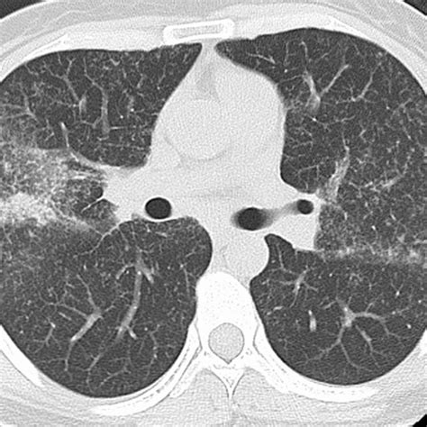 Ct Scan Showing Multiple Nodular Lung Lesions And Mediastinal And Hilar