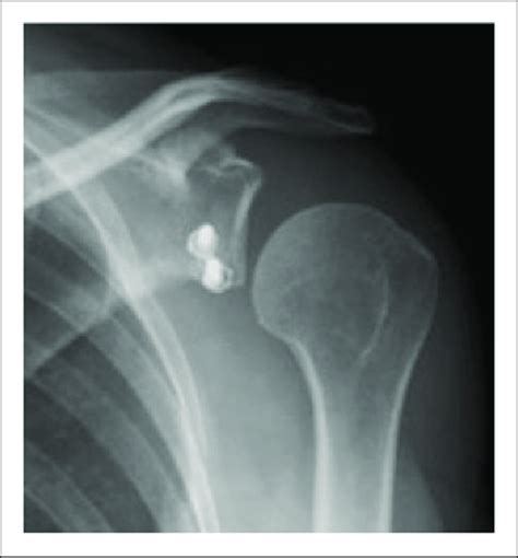 Inferior Static Subluxation Of The Humeral Head After Latarjet