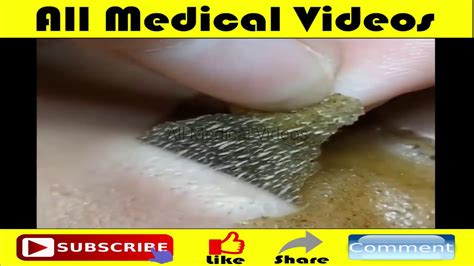 POP S HUGE CYST LIKE PIMPLE All Pimples Whitehead Blackhead Removal Video All Medical