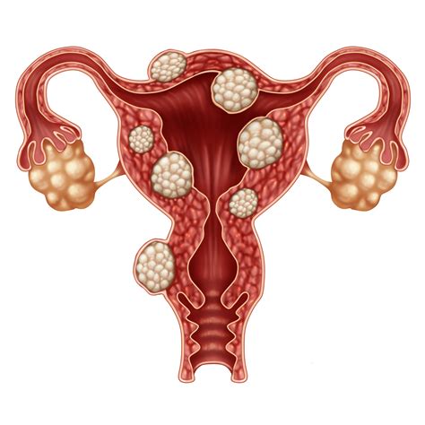 What Is Uterine Fibroid Embolization Ufe Central Oregon Radiology