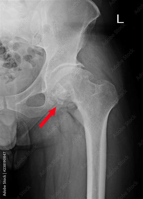 Sclerosis Of Articular Surface Of Acetabular With Marginal Osteophytes