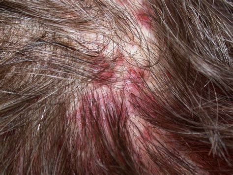 Folikulitis Uzroci Simptomi I Metode Tretmana 101 Hair Clinic
