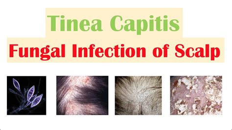 Fungal Infection Of The Scalp Tinea Capitis Causes Risk Factors Symptoms Diagnosis