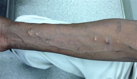 Derm Dx Multiple Cysts On The Torso And Arms Clinical Advisor