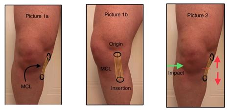 Mcl Medial Collateral Ligament Injury Nev Davies