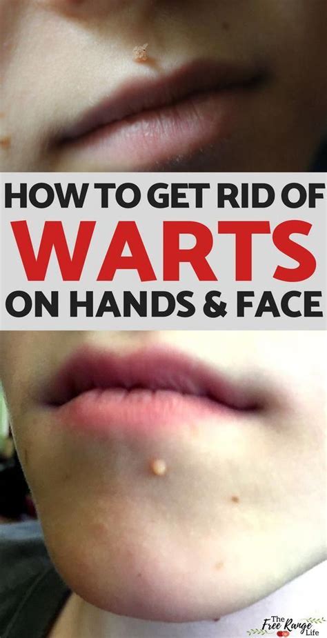 Natural Remedies Get Rid Of Warts Naturally With This Simple Trick