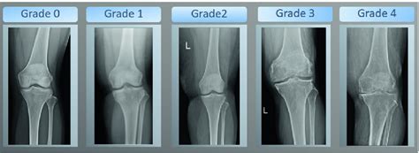 Stages Of Osteoarthritis Ashburn Physical Therapy Llc