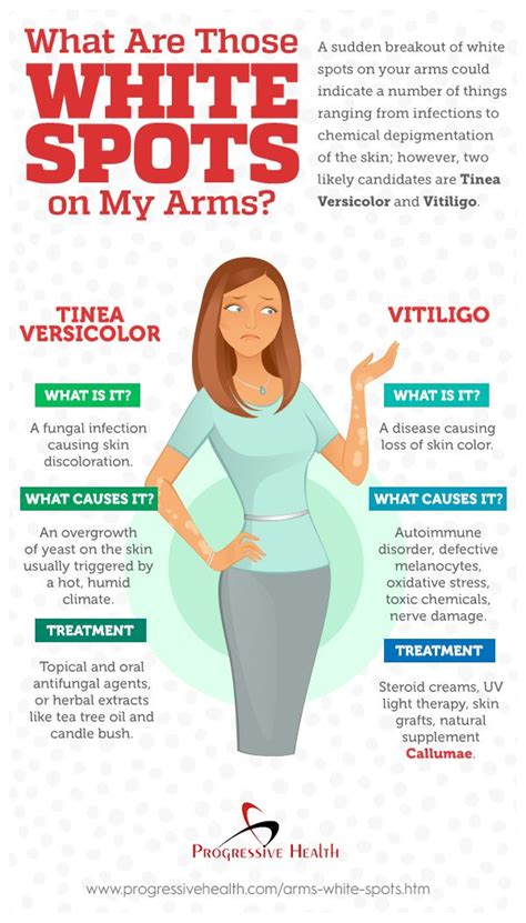 Vitiligo is sometimes associated with more. Those white spots on your arms can be caused by fungal ...