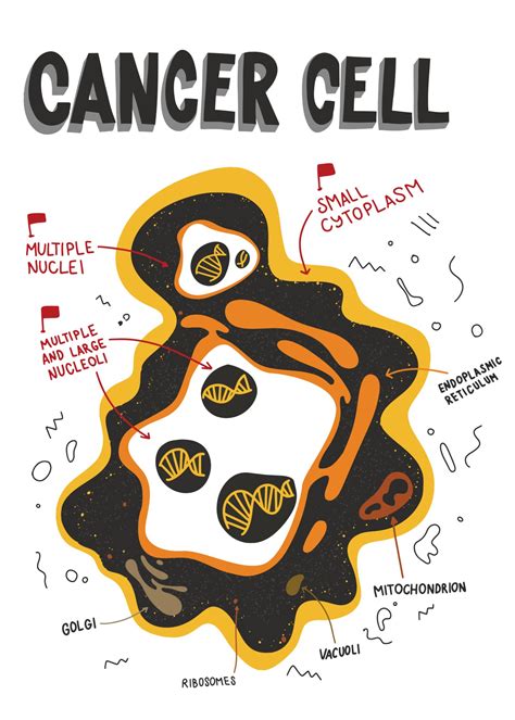Large Cell Carcinoma Medical Illustration Human Anatomy Drawing My