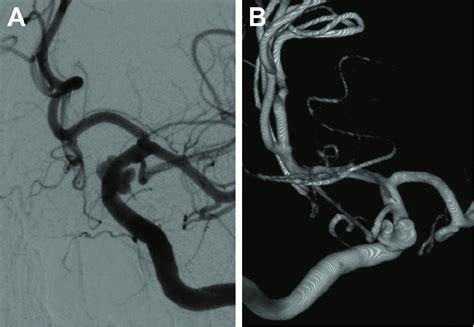 Head Dsa Images Showing Left Internal Carotid Artery Aneurysm In The