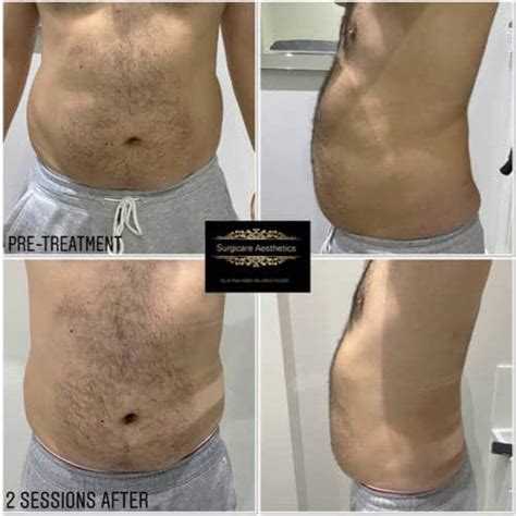 Aqualyx Fat Dissolving Barnet And Marylebone Surgicare Aesthetics