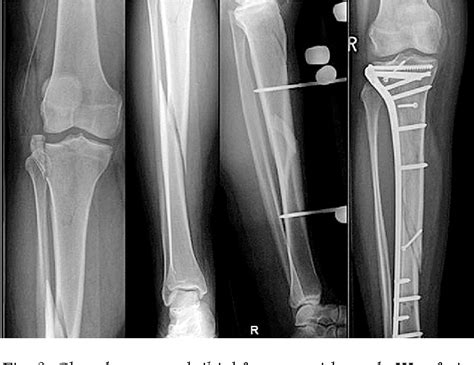 Figure 3 From Tibial Shaft Fractures Management And Treatment Options