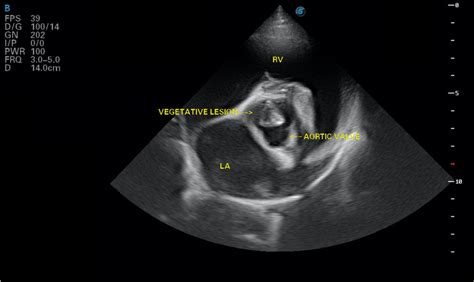 Aortic Valve Vegetation On Short Axis Echocardiographic View La Left