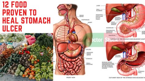 12 Food Proven To Heal Stomach Ulcer Youtube