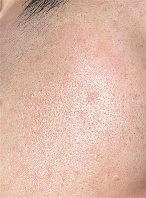 Skin Concern Enlarged Raised Pore On Face Skincareaddiction