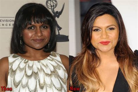 Mindy Kaling Plastic Surgery Before And After Photos