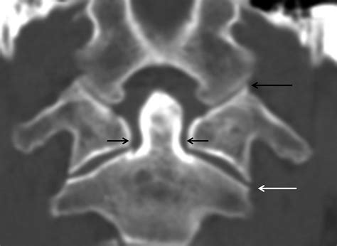 Traumatic Injury Of The Spine Radiology Key