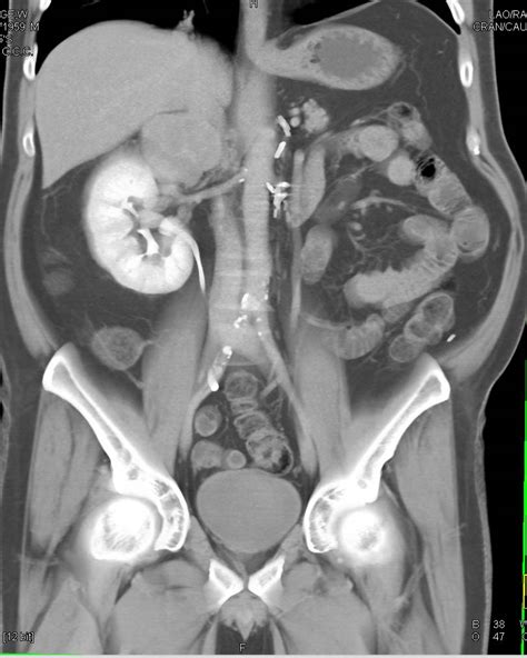 Renal Carcinoma Metastatic To Contralateral Adrenal Gland Adrenal