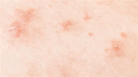 Liver Disease Red Spots