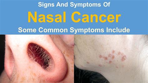 Signs And Symptoms Of Nasal Cancer Youtube