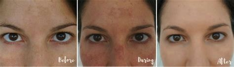 Before And After Laser Treatments For Hyperpigmentation Babeskills