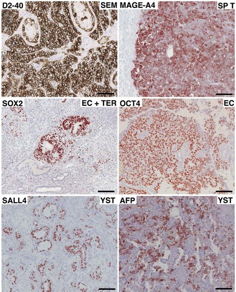 Examples Of Immunohistochemical Markers For Different Histological
