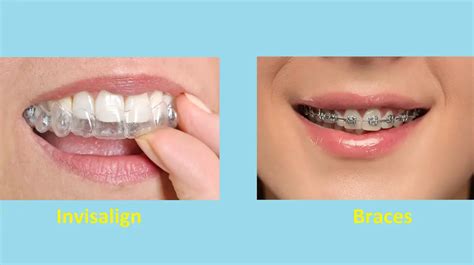 Difference Between Invisalign And Braces With Comparison Table