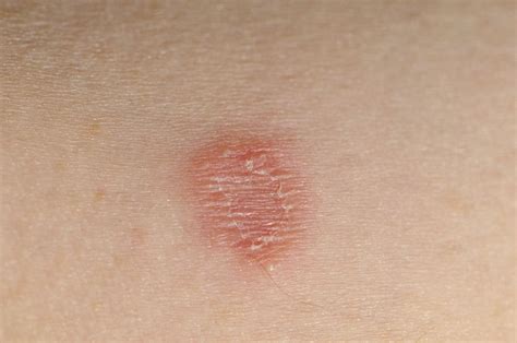 Skin Rashes Types And Causes In Children