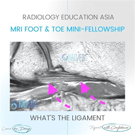 Mri Plantar Ligament Short Plantar Ligament Ankle Foot And Toe Video