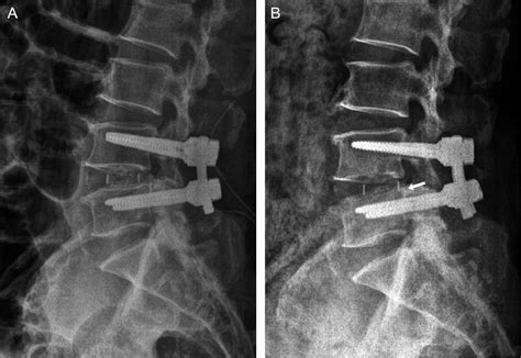 Risk Factors For Cage Migration And Cage Retropulsion Following Transforaminal Lumbar Interbody