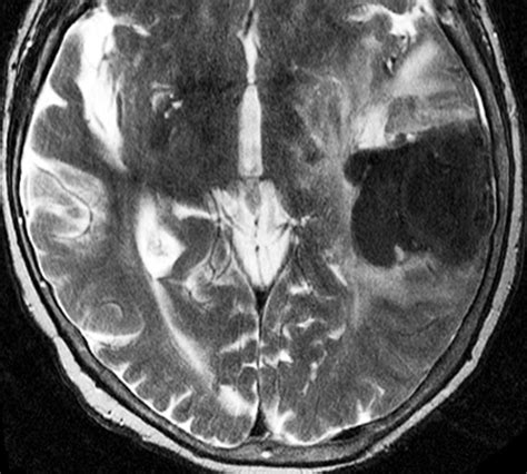 Subacute Hematoma Mri Methemoglobin Questions And Answers In Mri