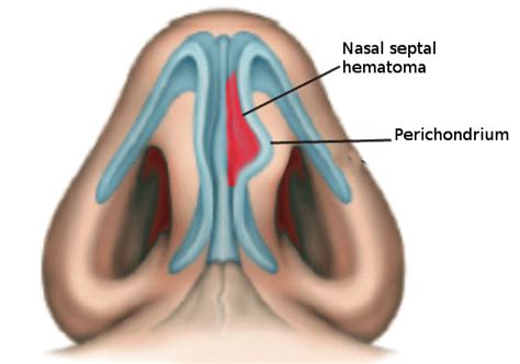 Nasal Septal Hematoma StatPearls NCBI Bookshelf