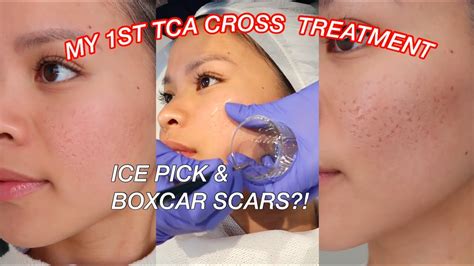 Tca Cross For Acne Scars L Ice Pick And Boxcar Scars On Asian Skin Youtube