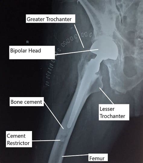 Uncemented Vs Cemented Total Hip Replacement Complete Orthopedics