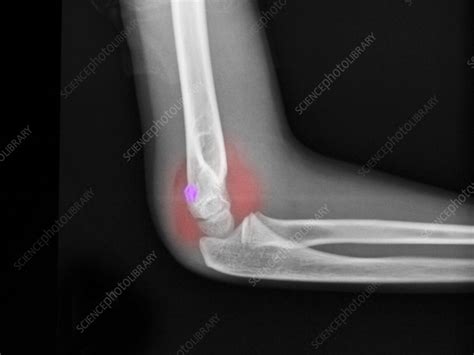 Distal Humerus Fracture In A 7 Year Old B Stock Image C0094760