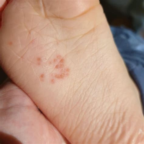 Is This Dyshidrotic Eczema 30f Incredibly Itchy Bumps On Toes Just