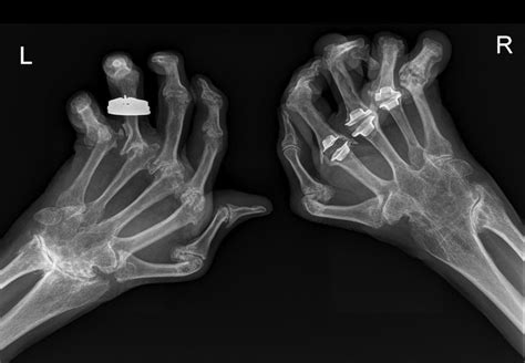 Rheumatoid Arthritis Hands Radiology At St Vincents University