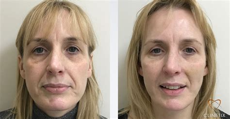 Face Thread Lift Before And After