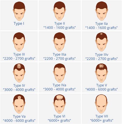 Hair loss patterns such as male pattern balding are often thought to be genetic.actually indicate organs hair loss patterns guide you in identifying and understanding the cause of the hair loss. Male Pattern Hair Loss - Hair Loss In Men