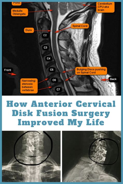 3 Level Cervical Fusion Recovery Time Ai Asbury