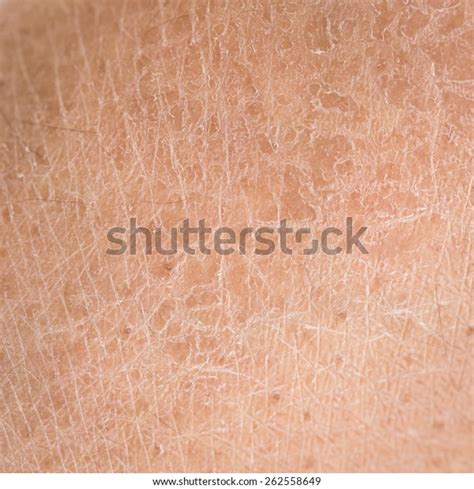 Macro Dry Skin Ichthyosis Detail Stock Photo Edit Now 262558649
