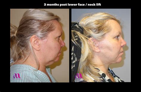 Plastic Surgery Neck Lift