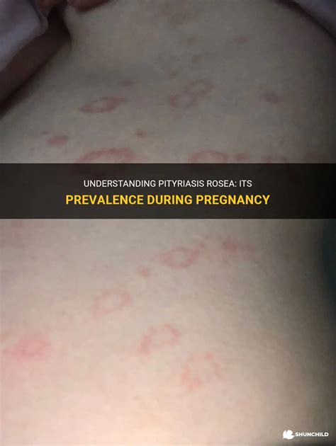 Understanding Pityriasis Rosea Its Prevalence During Pregnancy Shunchild